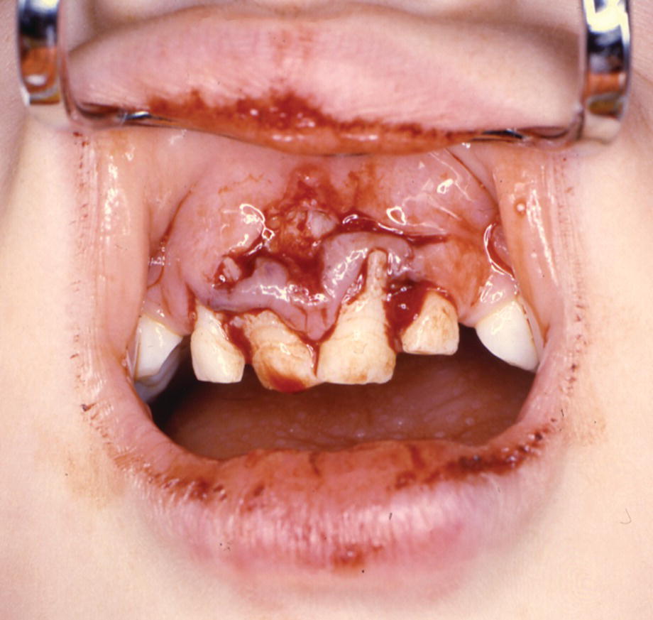 Photo displaying lateral luxation of three primary incisors and extensive gingival laceration.