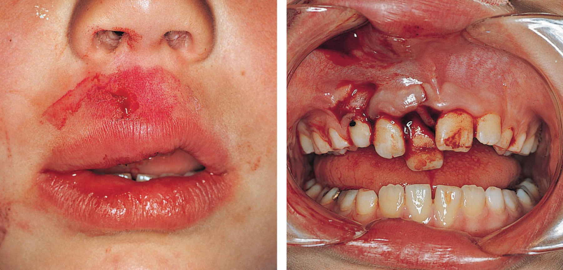 2 Photos of lip laceration and abrasion (left) and displacement of the right central and lateral incisors of a patient (right).