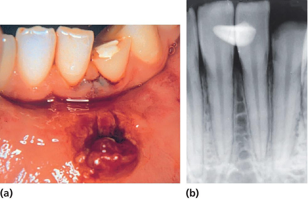 Photo of crown fracture of mandibular lateral incisor and mandibular lip lesion (left) and radiograph revealing the fractured tooth fragment in the lip lesion (right).