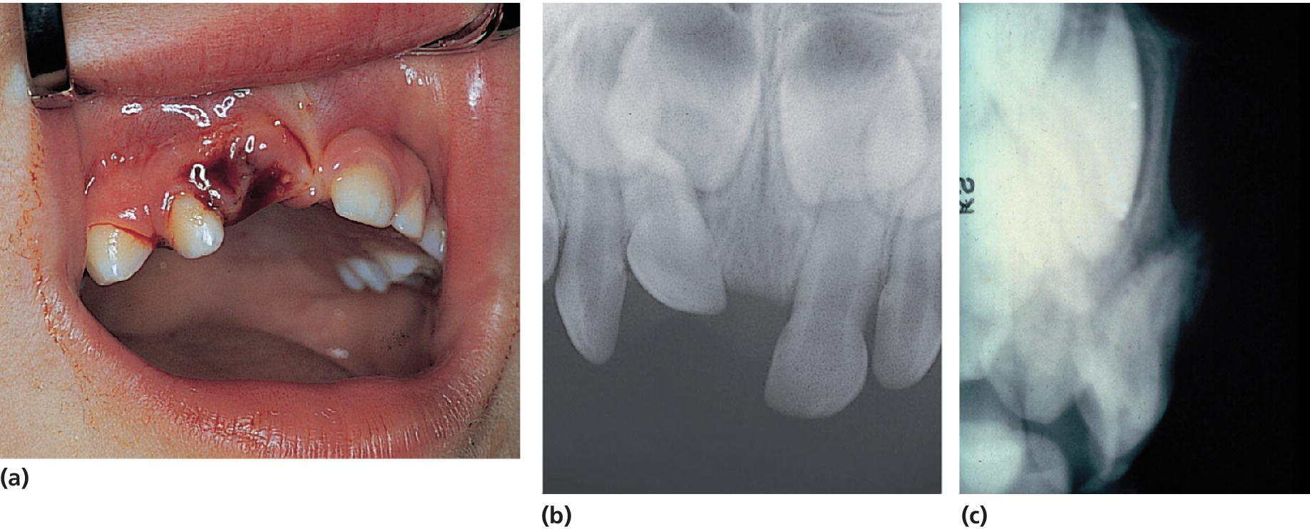 Photo of severe intrusive luxation of the primary right central incisor (a), radiograph of occlusal exposure with foreshortening of intruded tooth (b), and lateral radiograph of apex of intruded incisor (c).