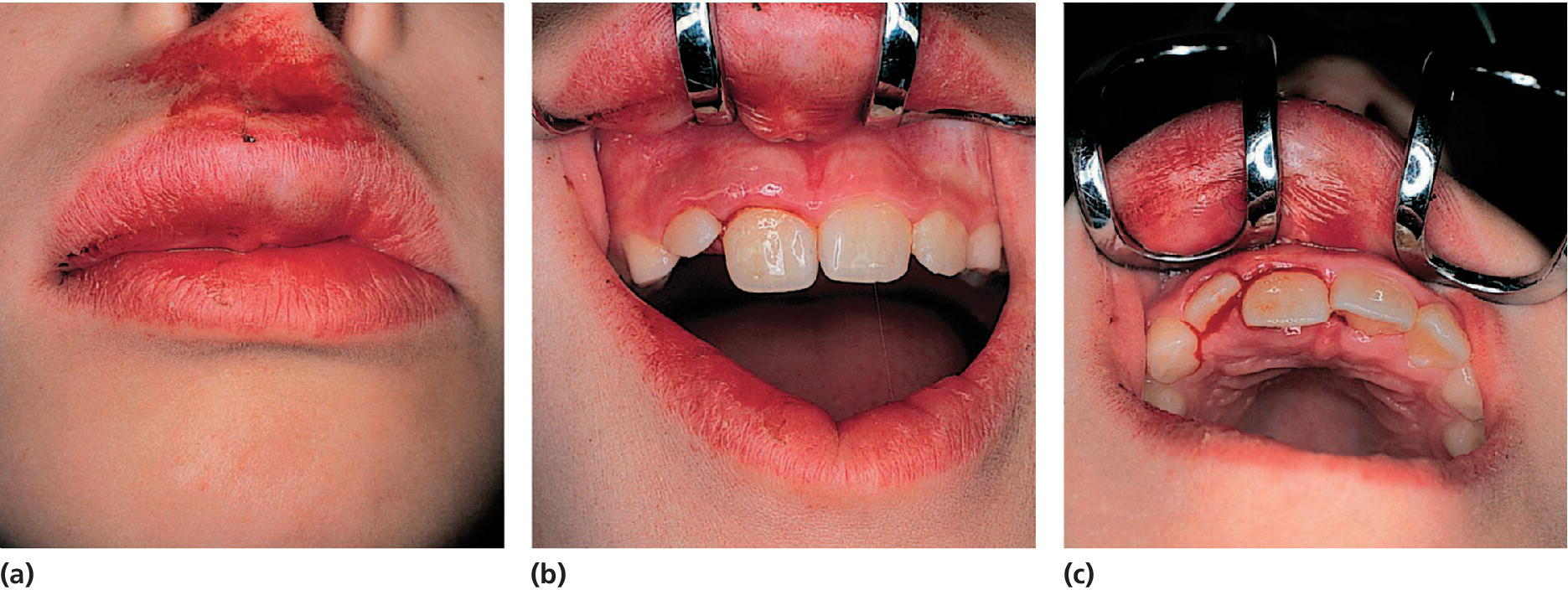 3 Photos illustrating clinical appearance after lateral luxation of the right central incisor.