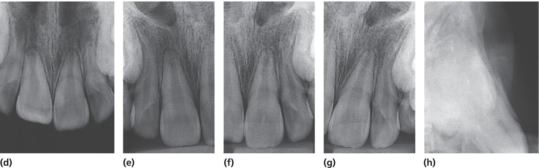 One occlusal and three periapical radiographs presenting buccal displacement of the root (d–g). Lateral radiograph displays location of the fracture of the buccal bone plate.