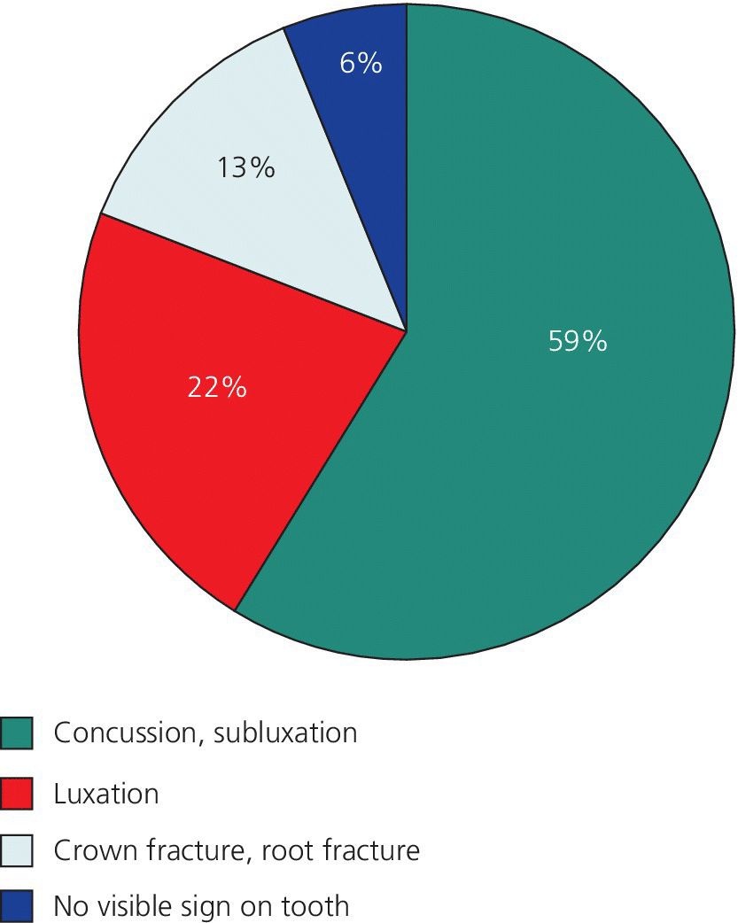 Pie graph of percentage distribution of diagnoses for traumatized primary teeth: concussion, subluxation (59%); luxation (22%); crown fracture, root fracture (13%); and no visible sign on tooth (6%).