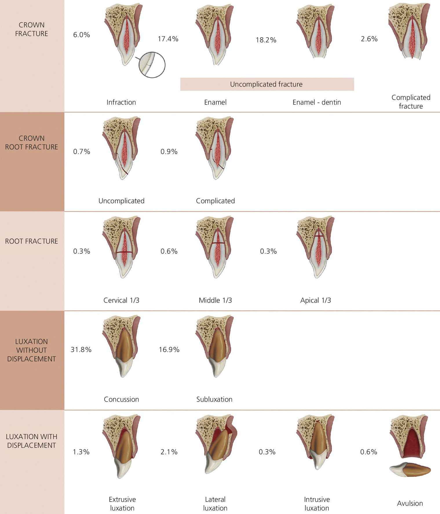 Illustrations of the distribution of 2019 traumatized permanent teeth with crown fracture, crown root fracture, root fracture, and luxation with and without displacement.