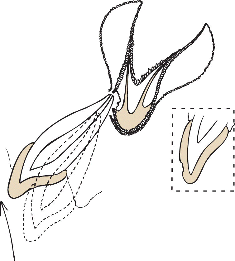 Schematic drawing illustrating developmental disturbance of permanent tooth bud at the age of 2 years.