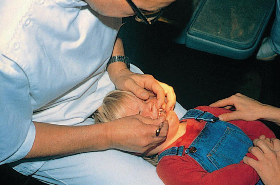 Photo of a child patient with his head resting on the lap of a dentist who examines his mouth.