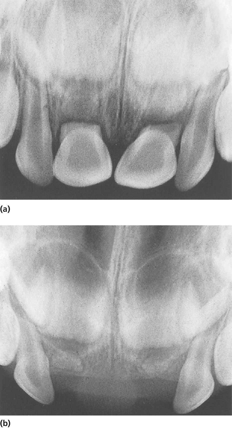 Radiographs displaying fractured roots of both central incisors with dislocation of the coronal fragments (left) and normal resorption of the apical fragments after removal of the coronal fragments (right).