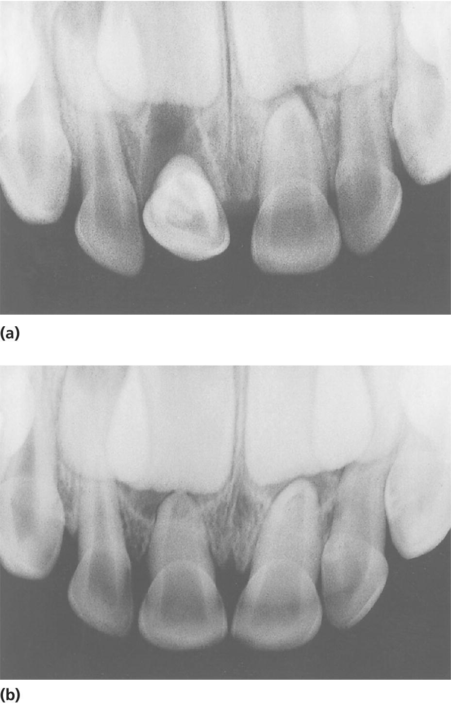 Radiographs displaying severe palatal luxation of the right central incisor (top) and tooth which is back in normal position due to tongue pressure (bottom).