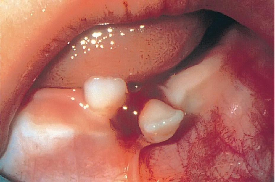 Photo displaying clinical condition immediately after buccal displacement of the left central incisor in an 8-month-old girl.