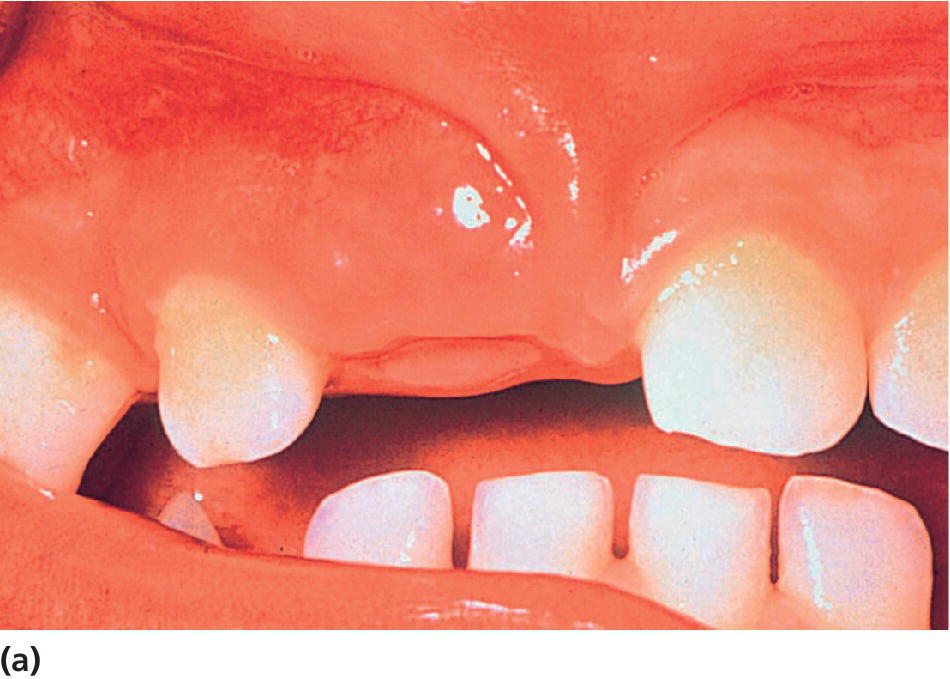 Photo of the teeth of an 18-month-old child. The right central incisor is missing.