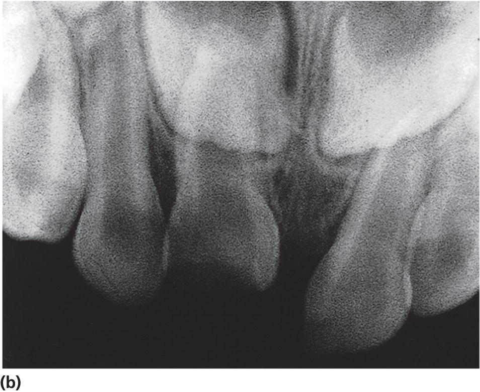 Radiograph displaying severe intrusive luxation in a 18-month-old child.