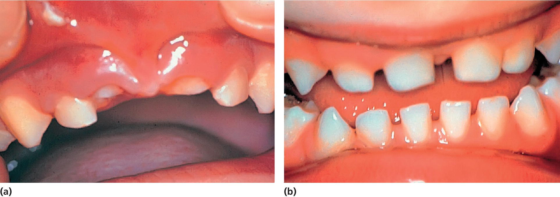 Photos displaying the condition immediately after intrusive luxation of both central incisors (left) and re-eruption evident 6 months later (right).