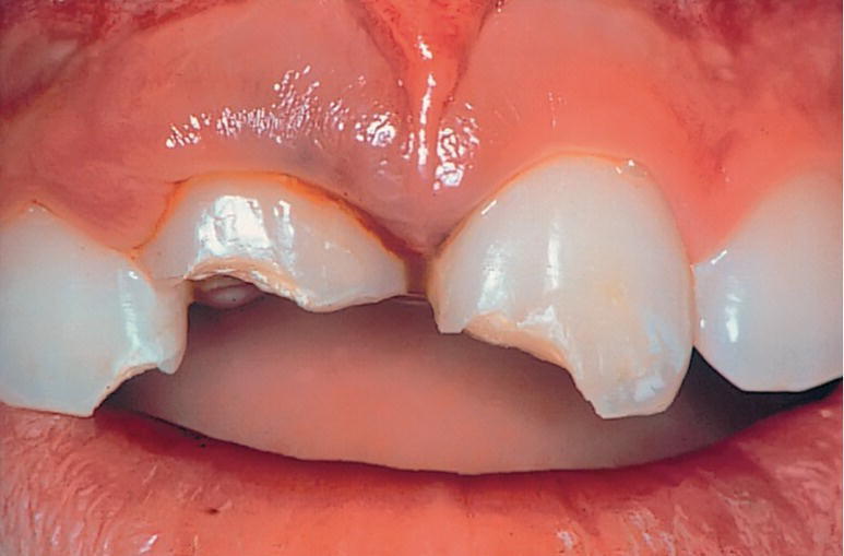 Photo displaying uncomplicated crown fracture involving either mesial corners or entire incisal edge.