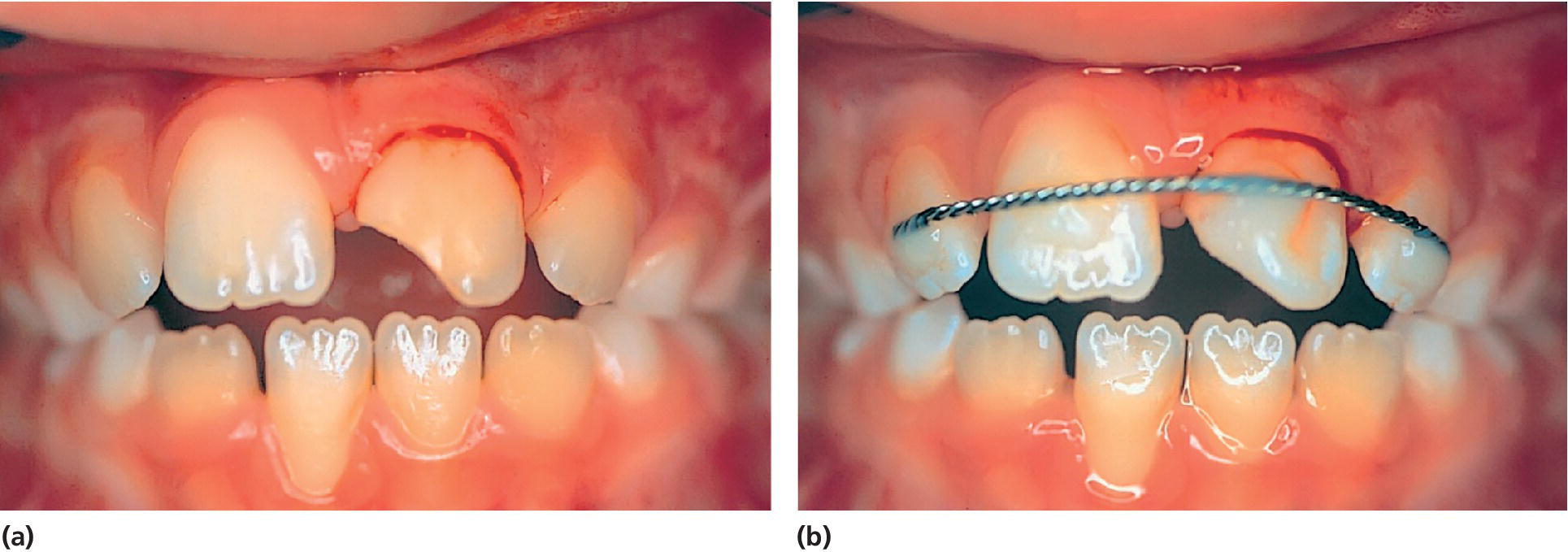 Photos displaying both subluxation and uncomplicated crown fracture in the left central incisor (left) and tooth stabilized with a splint and applied temporary crown restoration (right).