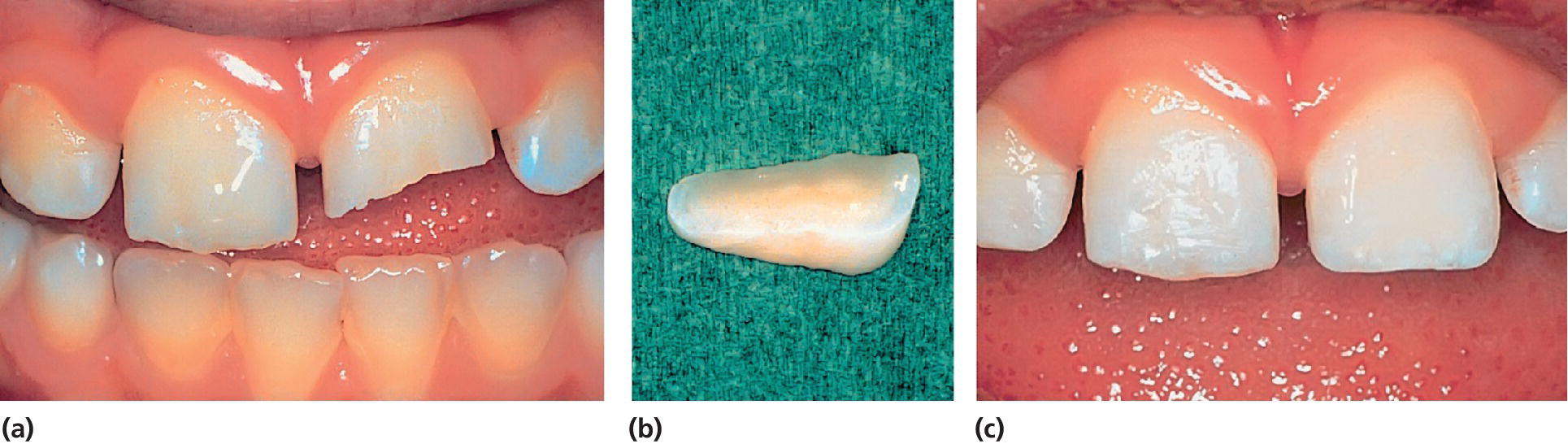 Photos displaying enamel–dentin fracture of the left central incisor in an 8‐year‐old boy (left), fractured crown fragment (center), and condition immediately after reattachment of the fragment (right).