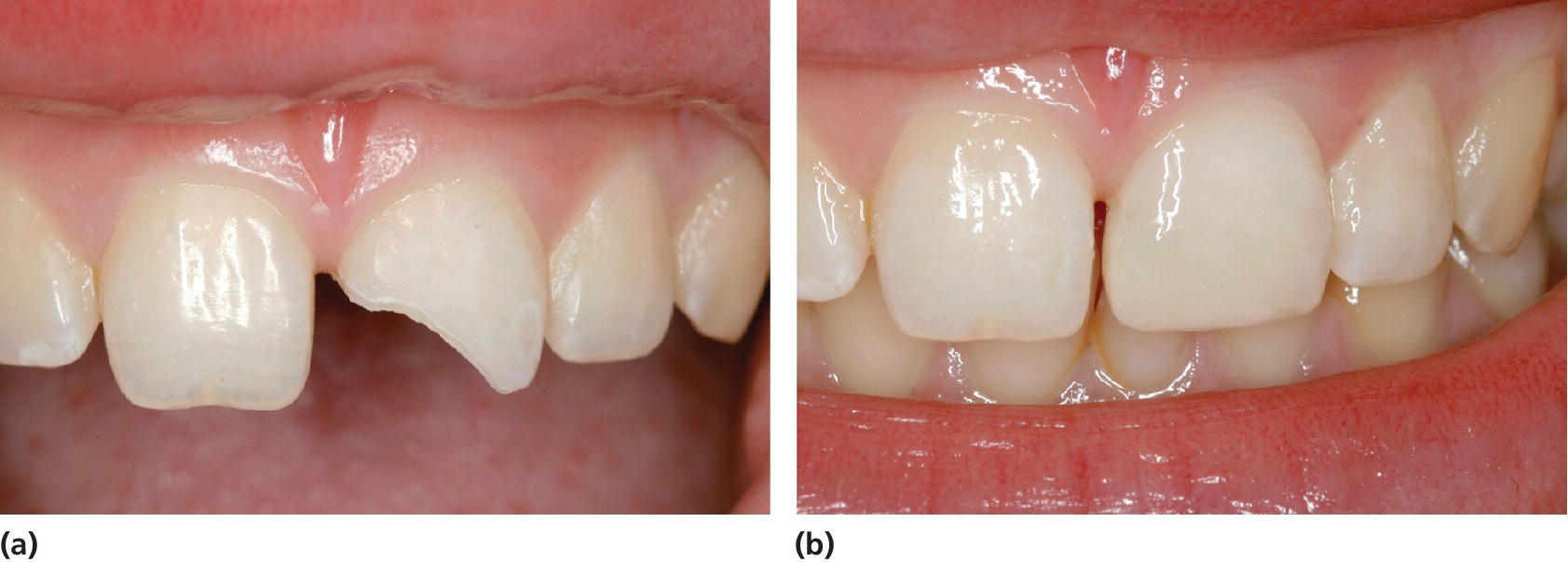 Photos displaying a 12‐year‐old girl with enamel–dentin fracture of the left central incisor (left) and condition shortly after the composite crown build-up (right).