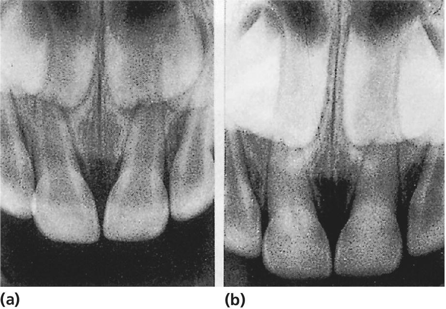 2 Radiographs revealing subluxation of both central incisors leading to pulp canal obliteration at time of injury (left) and almost total obliteration of the pulps two years later (right).