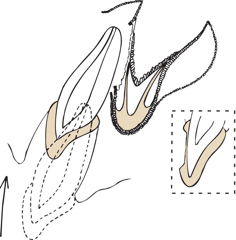 Line drawing displaying disturbance of development of permanent tooth bud due to intrusion of primary incisor and due to laceration of the follicle, disturbances in enamel formation will develop.