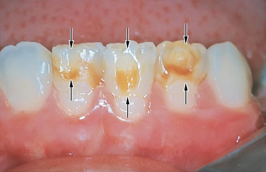 Photo displaying enamel defects in three mandibular incisors (arrows) resulting from avulsion of corresponding predecessors at the age of 2 years.