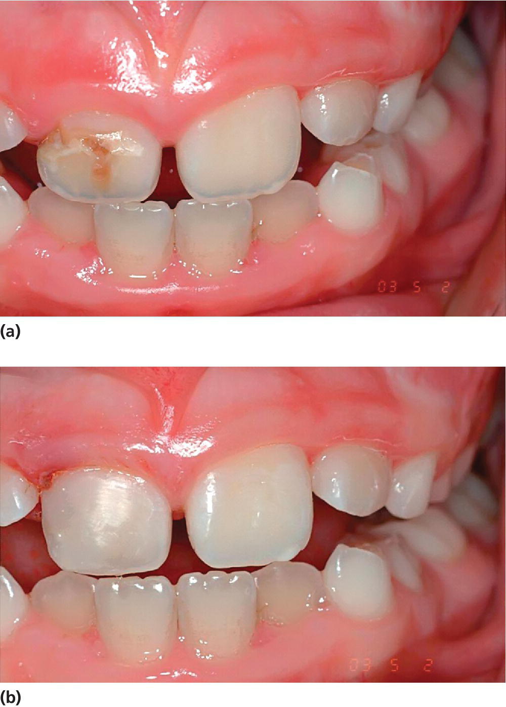 2 Photos displaying external enamel hypoplasia of right central incisor caused by intrusion of predecessor at the age of 18 months with hypoplastic area covered with composite.