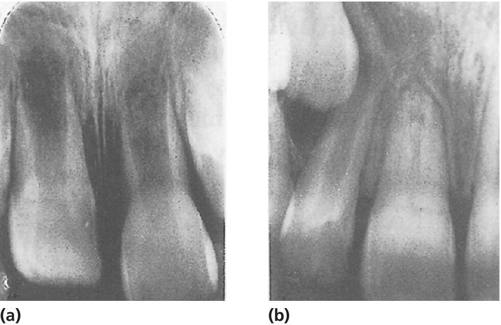 2 Radiographs displaying intrusive luxation of immature right central incisor (left) and spontaneous re‐eruption, closure of apical foramen, and pulp canal obliteration that have occurred (right).