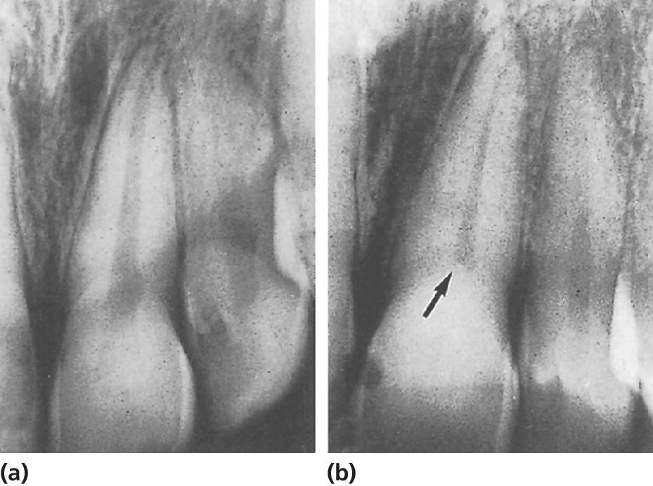 Radiographs of partial pulp canal obliteration in left central incisor at time of injury (a) and condition 15 yrs later with pulp chamber completely obliterated and root canal slightly reduced in size (arrow) (b).