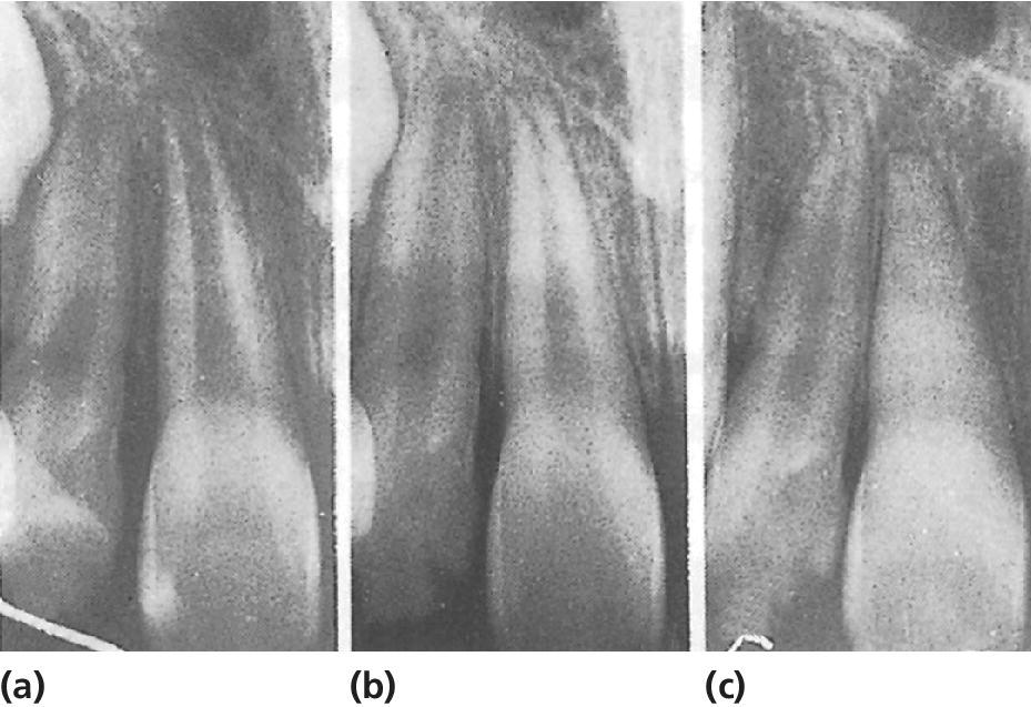 Radiographs displaying normal findings 3 weeks after replantation of right central incisor (left), 6 months later with apical closure (middle), and 7 years after replantation (right).