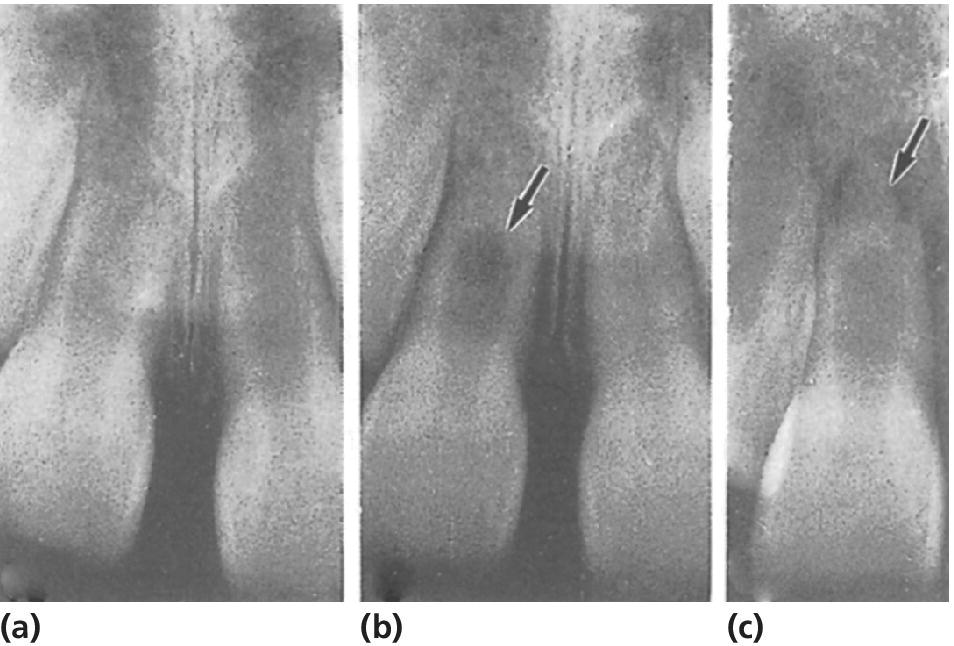 3 Radiographs of pulp necrosis of right central incisor after intrusion with re‐eruption occurring 3 months after injury (a), hard tissue formation, (b) and pulp necrosis diagnosed from periapical radiolucency (c).