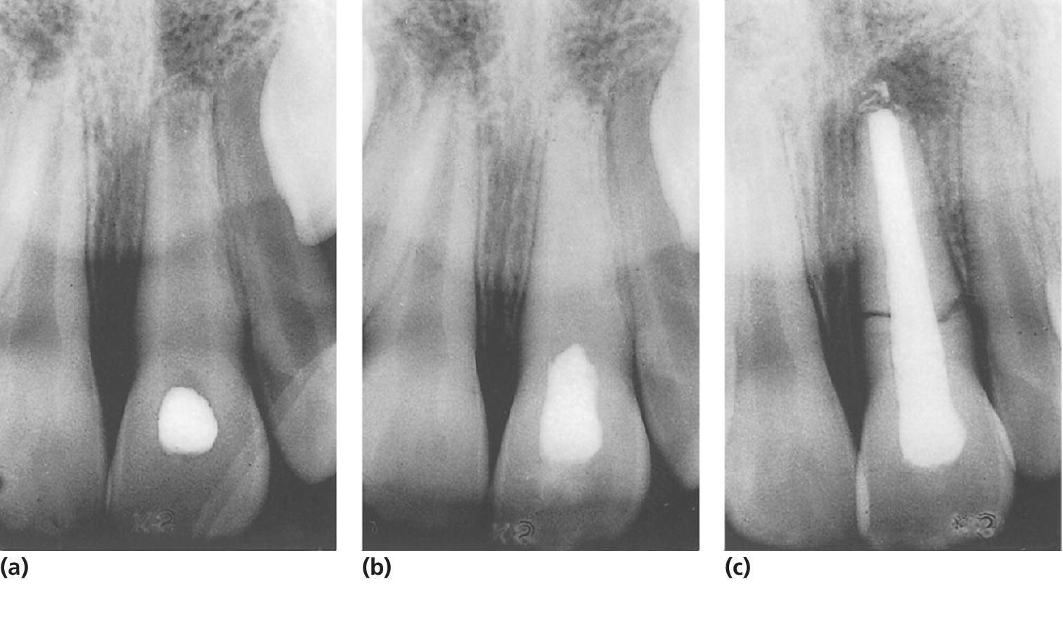 3 Radiographs of spontaneous root fracture of nonvital immature central incisor during long‐term treatment with calcium hydroxide (a, b) and fracture observed 1 year after completed endodontic treatment (c).