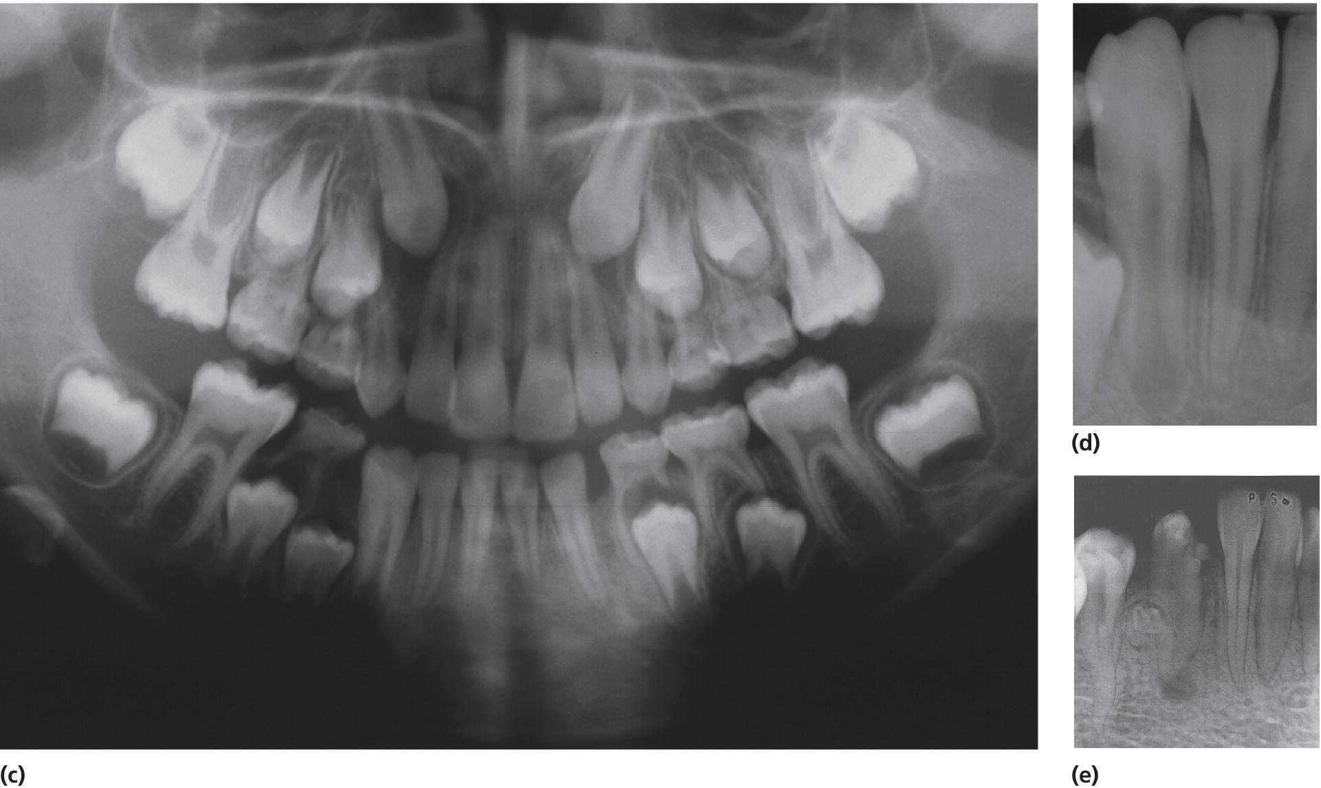 Left: Panoramic radiograph displaying no permanent left canine. Right: Radiographs of right lower canine with normal development (top) and of malformed crown and hypoplastic mandibular canine (bottom).