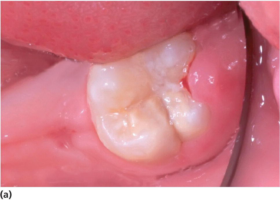 Photo displaying an erupting severely hypomineralized lower first molar with normal morphology.