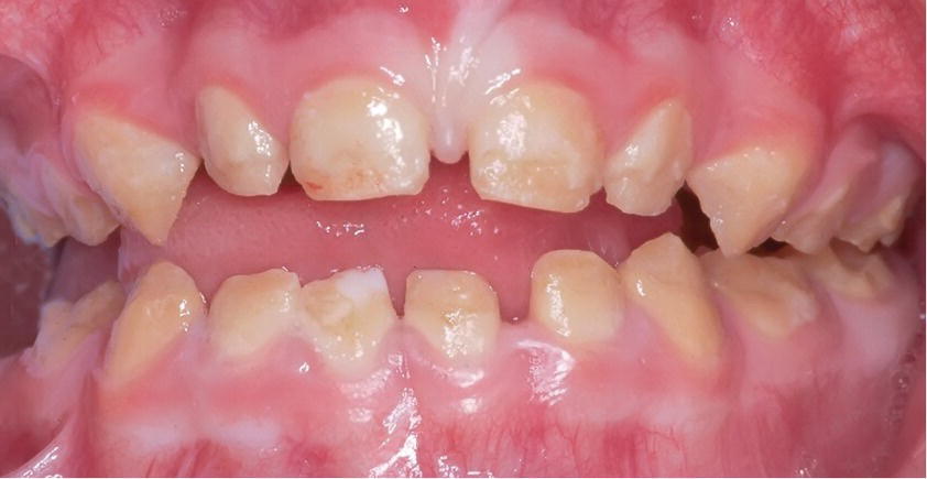 Photo displaying hypocalcified amelogenesis imperfecta (AI) in the primary dentition of a 3‐year‐old girl.