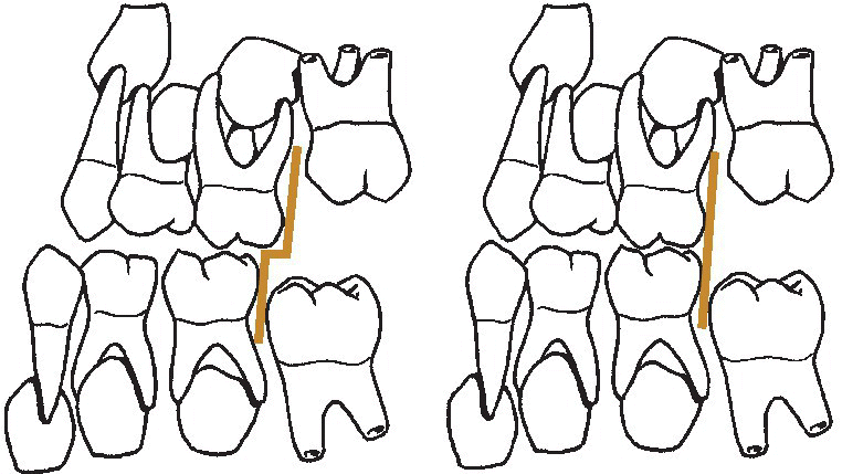 Line drawing of the terminal plane of the primary dentition. It displays the permanent molars erupting directly into normal occlusion (left) and permanent molars erupting into a cusp‐to‐cusp relation (right).