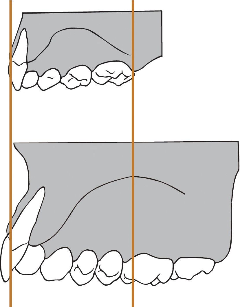 Illustration of permanent maxillary incisors erupting at a more labial inclination than their primary predecessors. Vertical lines display the different of width and length of the dental arch after eruption.