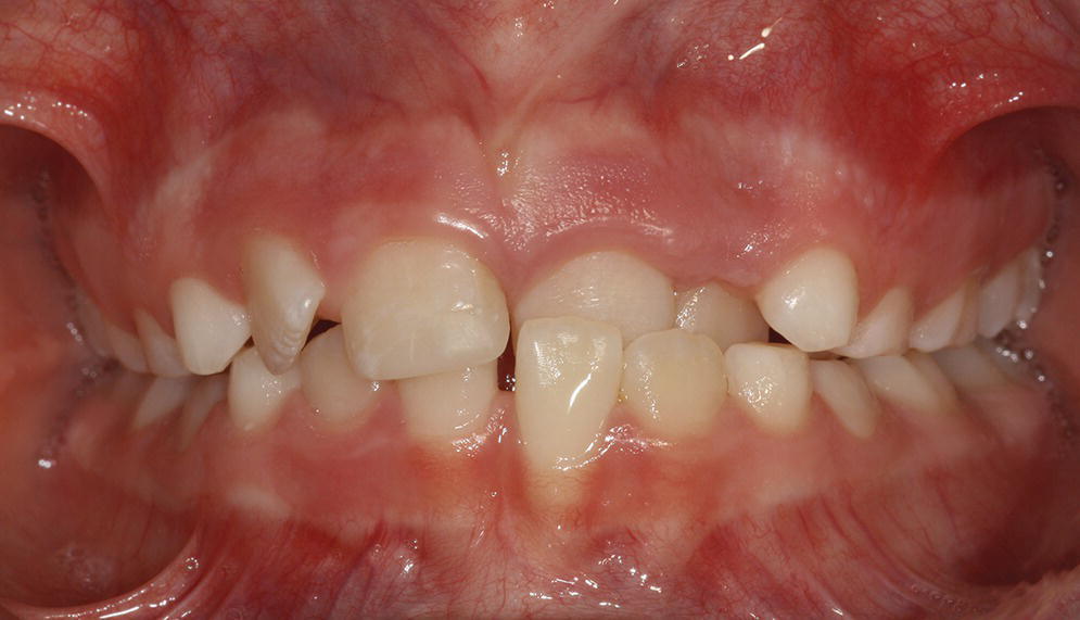 Photo of a human dentition displaying a dentoalveolar anterior cross bite.