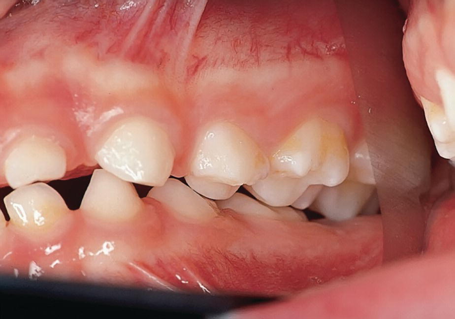 Photo of a human dentition displaying an unilateral scissors bite in the primary.