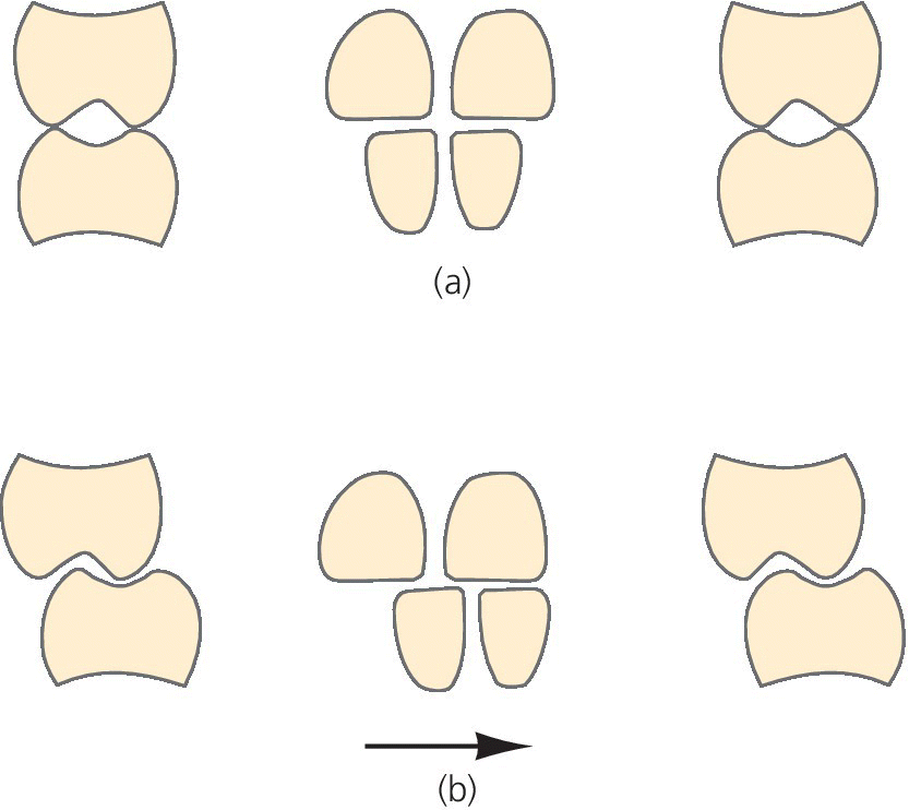 Diagram of forced posterior cross bite. It displays symmetrical jaws with narrow maxillary jaw. In retruded position, molars occlude cusp‐to‐cusp (top) and an occlusion with forcing of bite to the left (bottom).