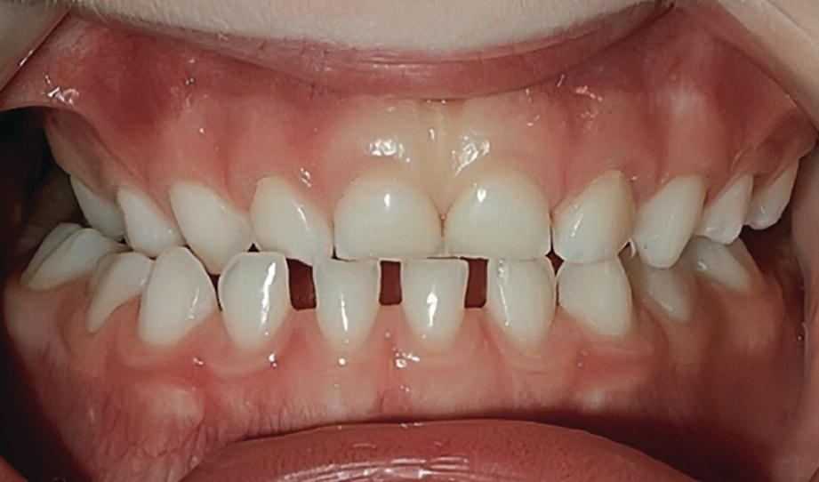 Photo of the "Classical” unilateral posterior cross bite. Narrow maxilla has lack of space with the mandibular midline forced to the cross bite side.