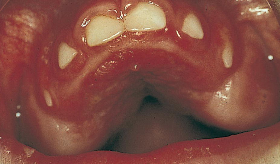 Photo of the dentition of a 3‐year‐old boy displaying a severe gingival overgrowth in the maxilla.