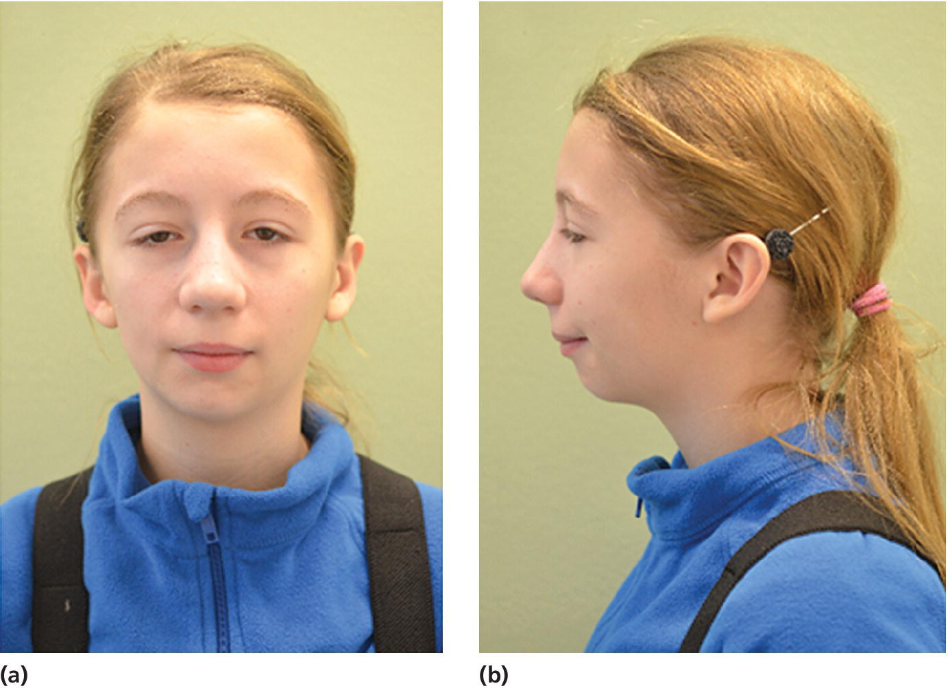 Left: Photo of a 14‐year‐old girl with restricted, asymmetric mandible growth as observed from the front. Right: Photo of a 14‐year‐old girl with restricted, asymmetric mandible growth as observed from the left.