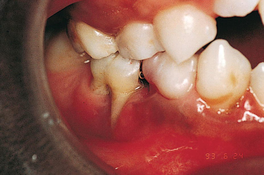Photo of the dentition of a 9‐year‐old boy with a congenital HIV infection exhibiting periodontal disease.