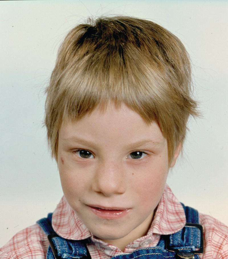 Photo of a child with fetal alcohol syndrome. It displays the small palpebral fissures, short nose, flat philtrum, and thin upper lip.