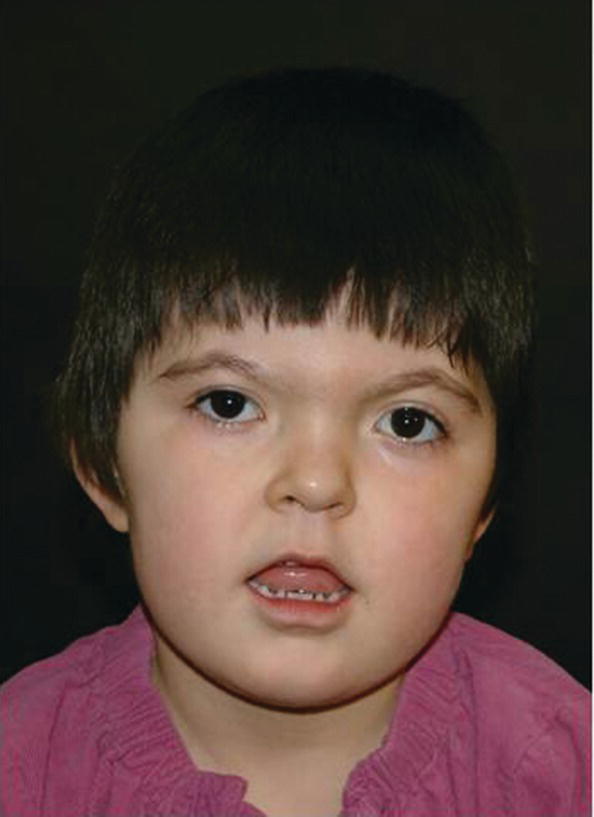 Photo of a 5‐year‐old girl with Apert syndrome. It displays hypertelorism, short nose, trapezoidal shape of mouth, and midface hypoplasia.