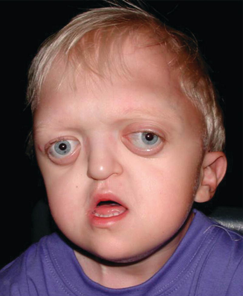 Photo of a 2‐year‐old boy with Crouzon syndrome. It displays hypertelorism, ocular proptosis, and midface hypoplasia.
