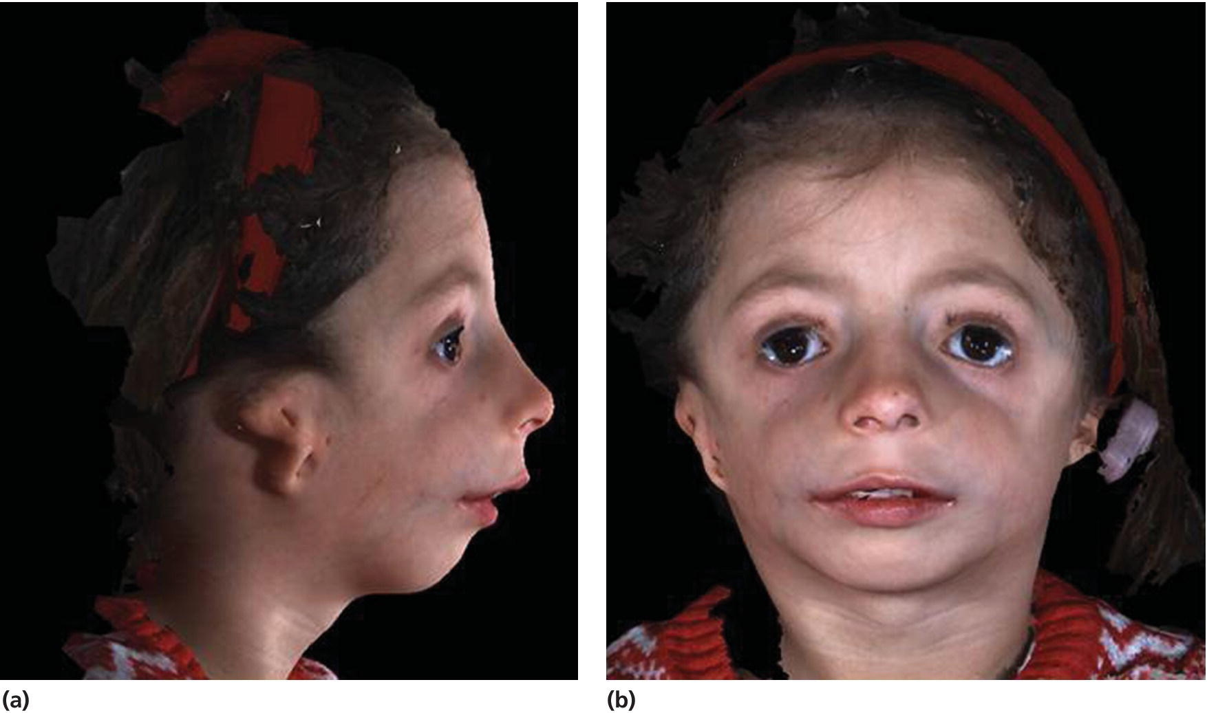 Photo of a 5‐year‐old girl with Treacher Collins syndrome. It displays the downslanting palpebral fissures, colobomas of the lower eyelids, mandibular hypoplasia, and microtia.