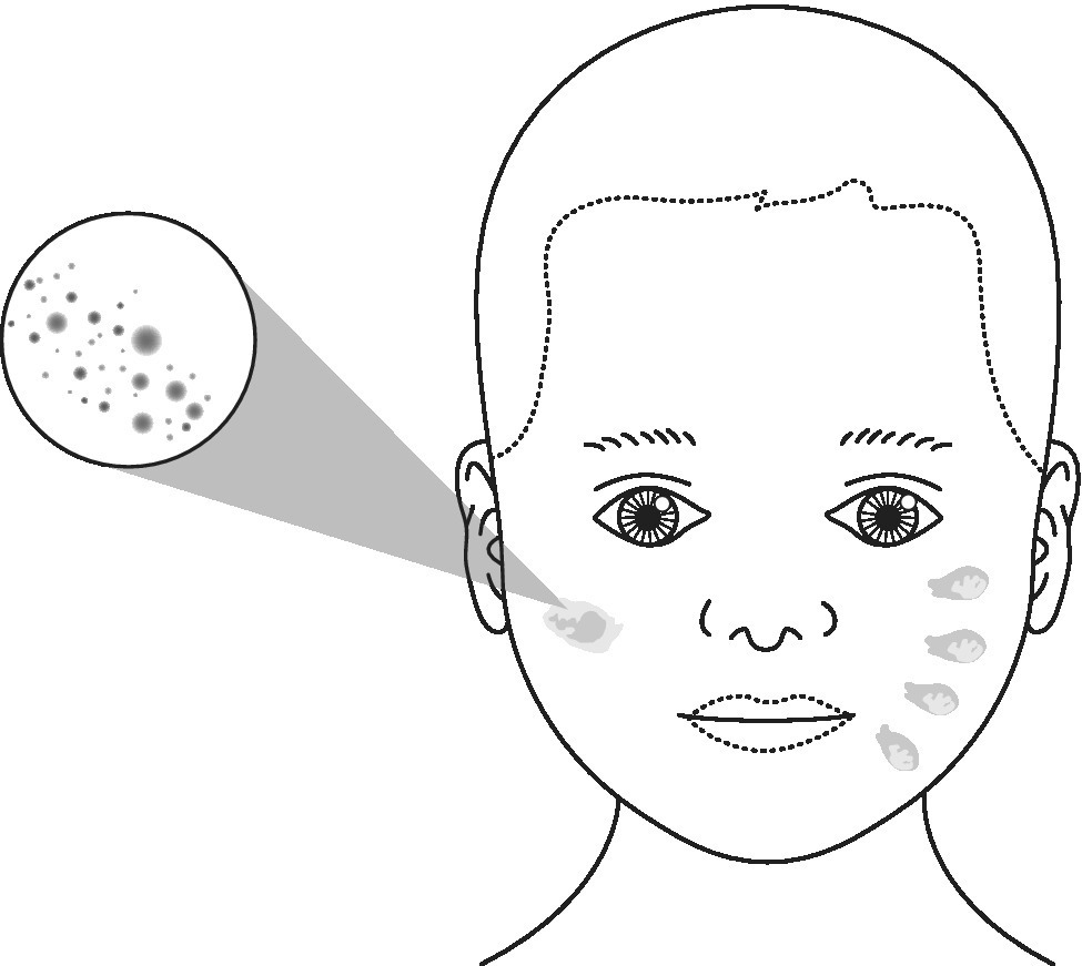 Illustration of a child’s head as observed from the left. It features slap marks on the cheek and petechial bruising at a finger width spacing (inset).