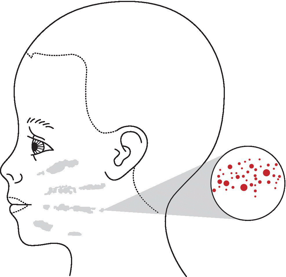 Illustration of a child’s head as observed from the front. It features finger marks on each cheek where it was gripped during forced feeding.