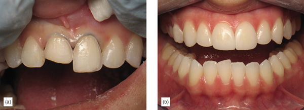 The Healthier Paradigm: Supragingival Minimally Invasive Adhesive ...