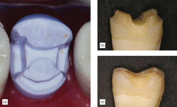 The Healthier Paradigm: Supragingival Minimally Invasive Adhesive ...