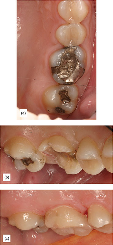 The Supragingival Protocol And Indications: Preventing Subgingival ...